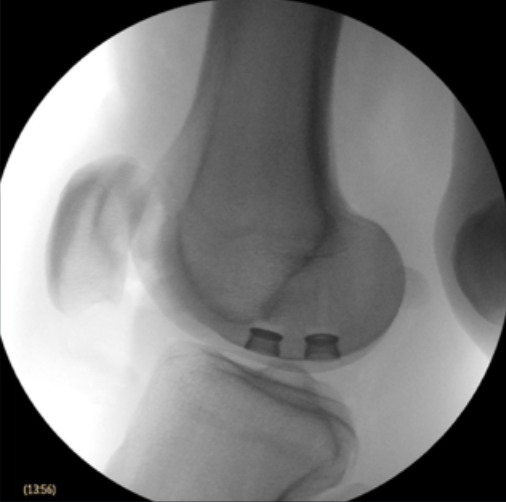 Implanted CyborGel Synthetic Cartilage GelPlugs